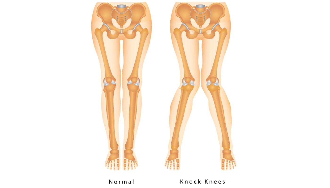 Genu Valgum (Knock Knees)