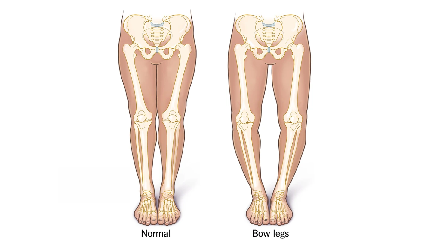 Genu Varum (Bow Legs)