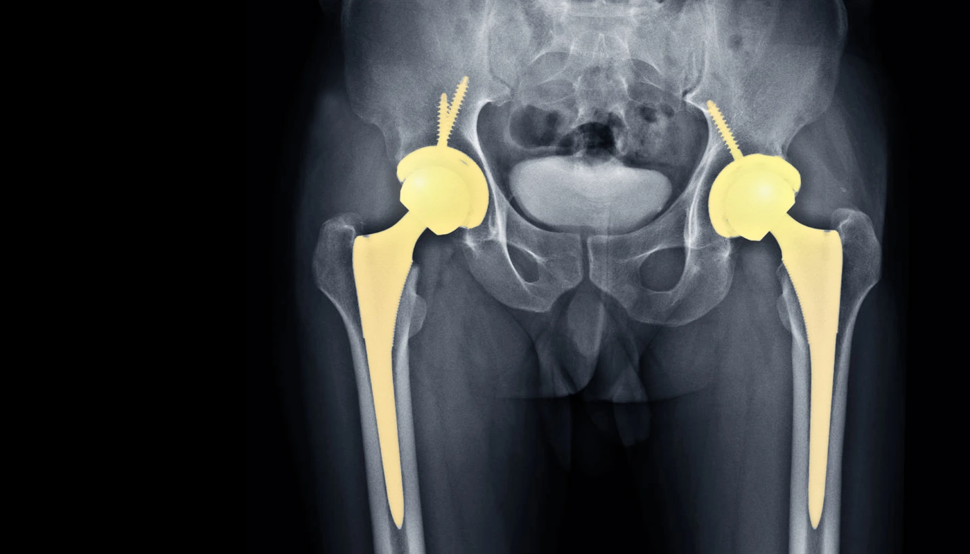 Total Hip Replacement