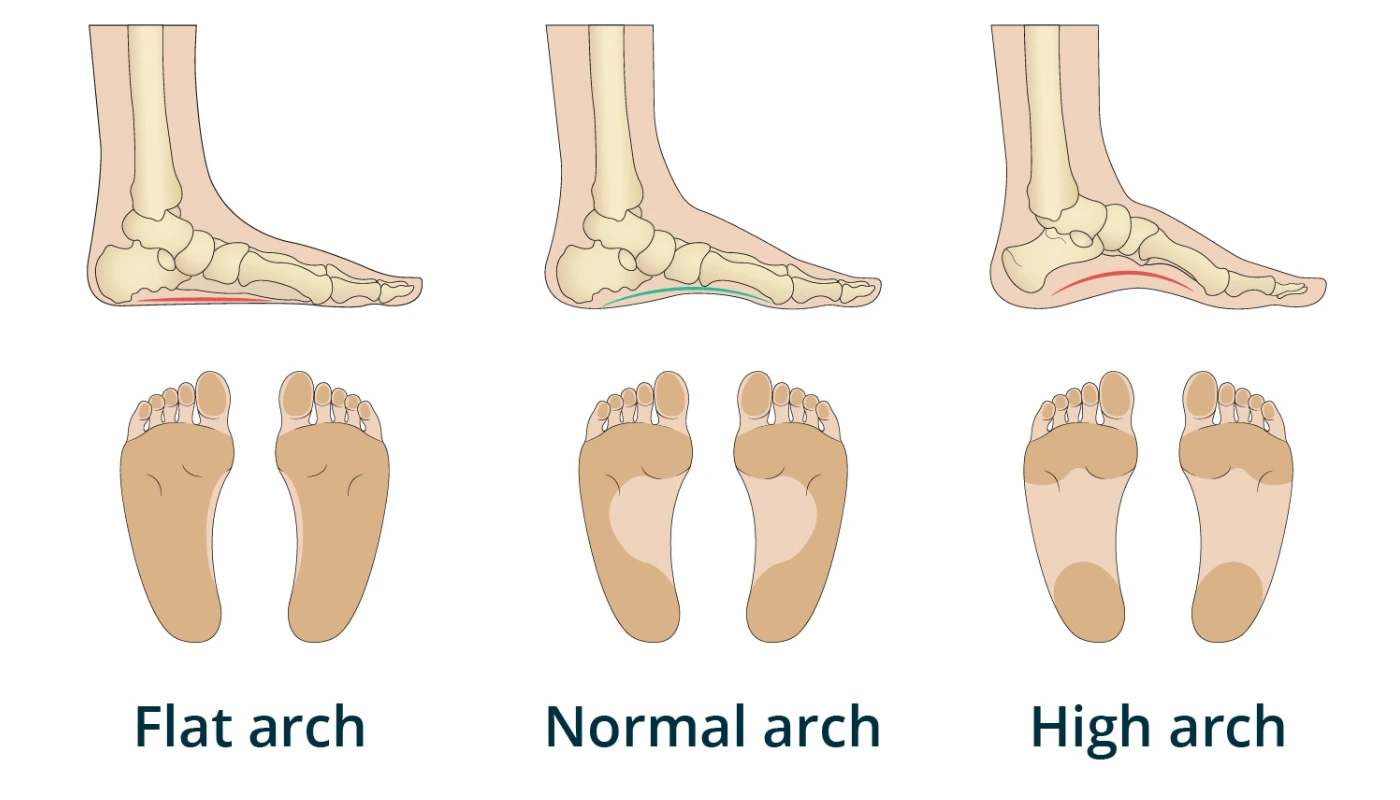 Flat Foot (Pes Planus)