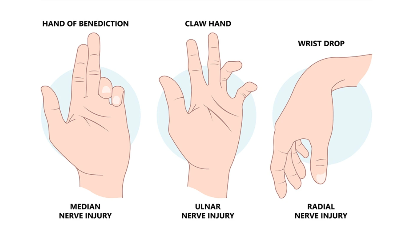 Median Nerve Injury